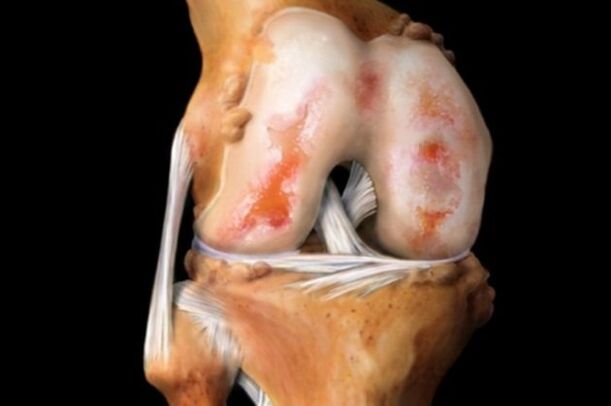 Dommages cartilagineux dans l'arthrose du genou. 