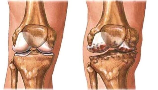 arthrose du genou et genou sain
