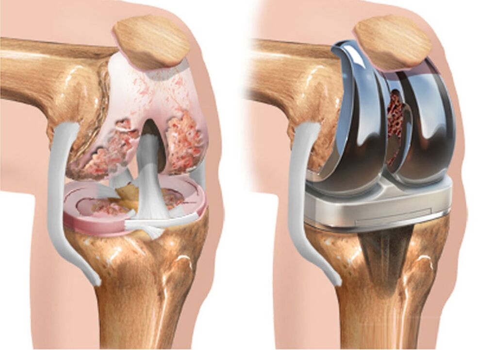 avant et après arthrose de l'articulation du genou due à l'arthrose