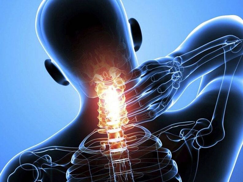 L'ostéochondrose de la colonne cervicale s'accompagne de douleurs au cou. 
